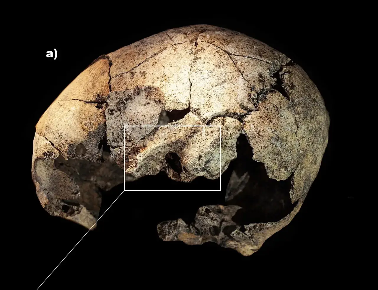 Starożytna czaszka z widocznym otworem po trepanacji. W powiększeniu widać ślady po zabiegu.